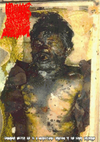 Ripping Off Your Herpe Scabs With A Power Sander : Ceasarean Section Due to a Sacroccygeal Teratoma in the Lower Vertebrae